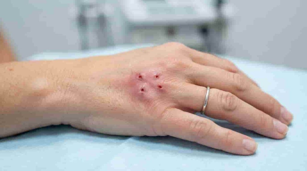 Why a Cat Bite on Hand Can Be More Serious Than It Looks